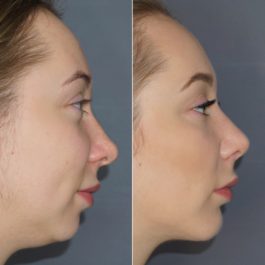 Коррекция кончика носа , септопластика , ментопластика, 1 месяц после операции.
